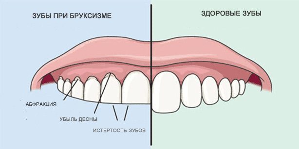 Skřípání zubů: Zdravé zuby a zuby během bruxismem