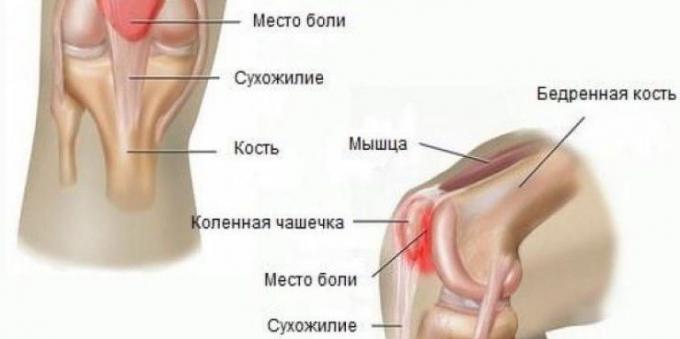 Proč bolí kolena: Syndrom patellofemoral bolesti