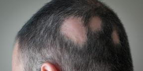 Alopecie: proč ztrácíte vlasy a jak s nimi zacházet