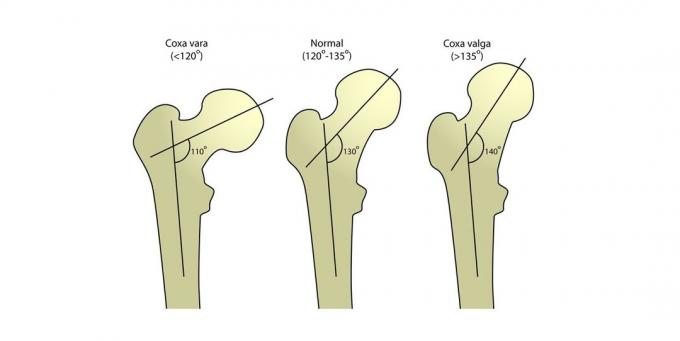 Krčku stehenní kosti: Angle