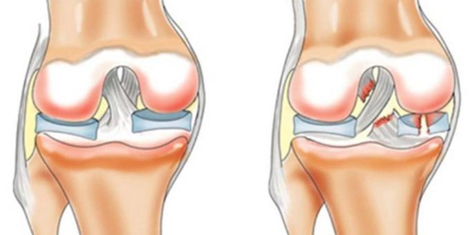 Proč bolet kolena: předního zkříženého vazu prasknutí