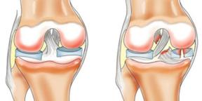 Proč kolena ublížit a co dělat