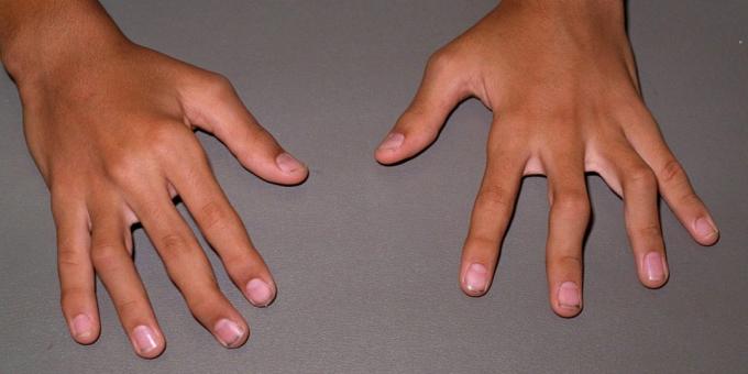 V pozdních stádiích rheumatoidní arthritis, jsou možná deformace a ohýbání kloubů
