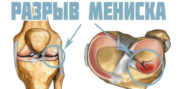 Proč bolet kolena: poranění menisku