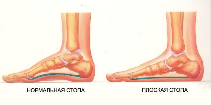 cvičení pro ploché nohy: normální a ploché nohy