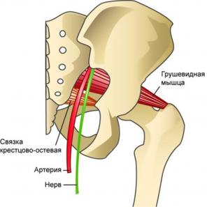 Co je piriformis syndrom a jak se ho zbavit