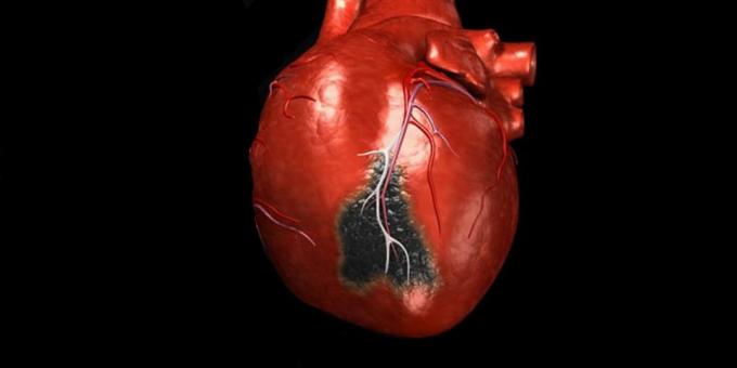 Příznaky srdečního infarktu, pro které je třeba volat sanitku