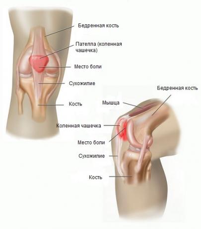 syndrom patellofemoral bolesti