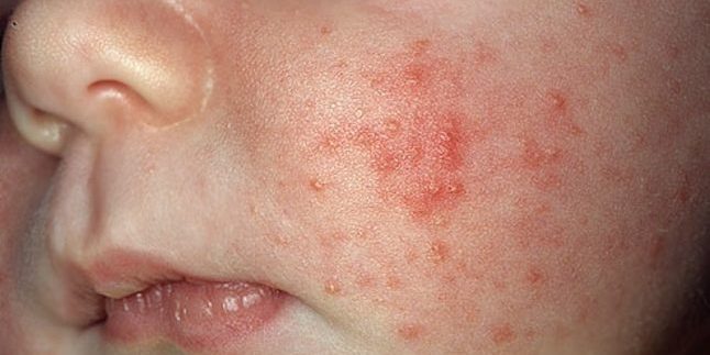 Jak se zbavit akné: Akné Infant