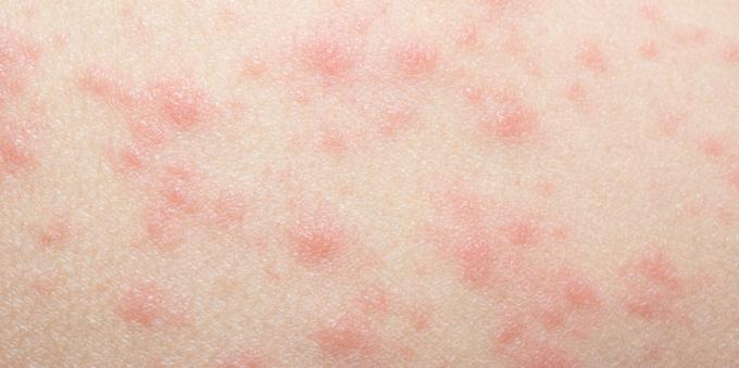 Kožní vyrážka s alergiemi na léky